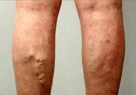 Thrombosis