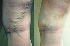 Intravenous veins on the legs