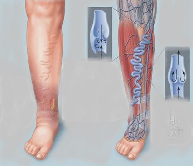 Varicose veins in the legs