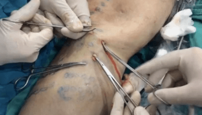 How to perform phlebectomy to remove varicose veins