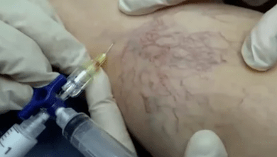 Sclerotherapy for varicose veins