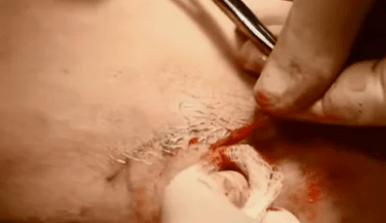 types that work to eliminate varicose veins