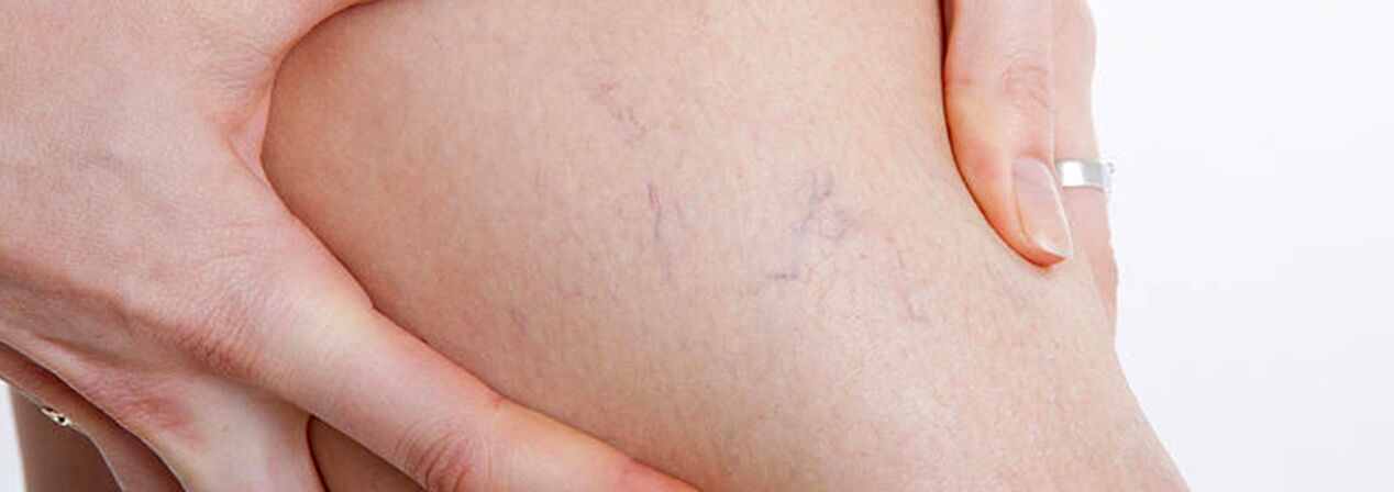 Spider veins are varicose veins