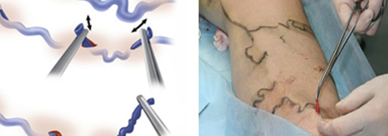 Surgical treatment of veins
