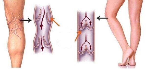 healthy veins and varicose veins
