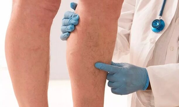 The doctor examines the legs to see if there are varicose veins